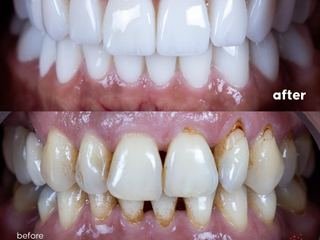 All-on-4 + Zirconium Crown on Implant — detail