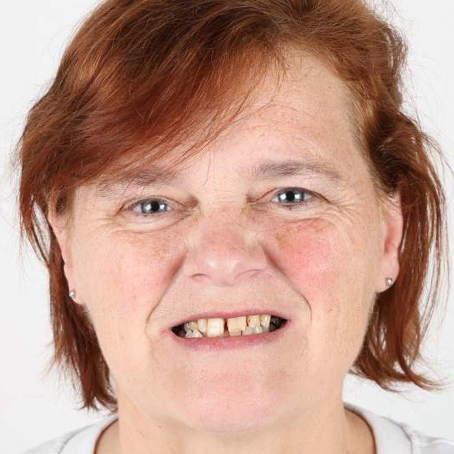 Smile makeover — Before
