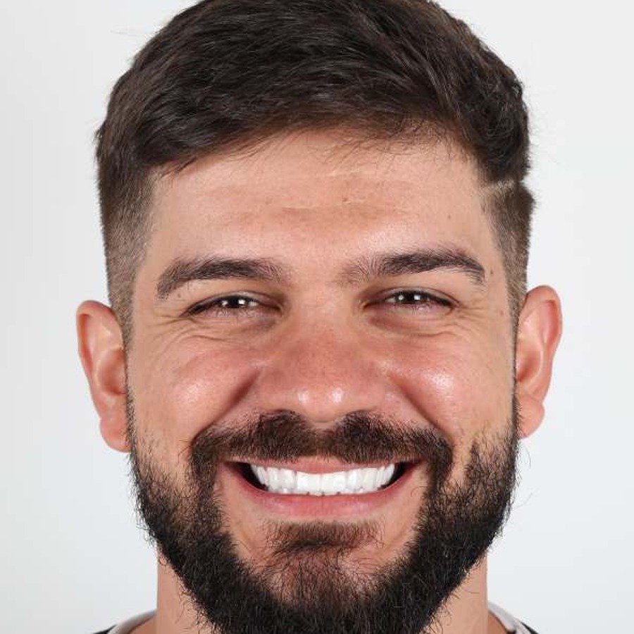 Smile makeover — After