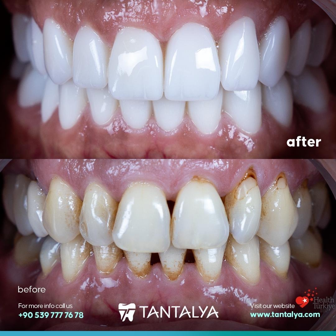 All-on-4 + Zirconium Crown on Implant — detail